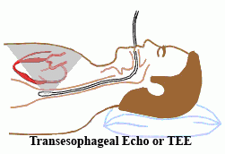 Transesophageal Echocardiography (TEE) 